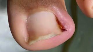 UM CANTO QUE DEU TRABALHO  alívio imediato #ingrown_toenail