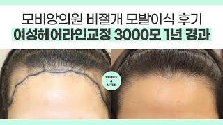 여성헤어라인교정 #여성모발이식 비절개 3000모 1년경과  l  #여성탈모치료 #대구헤어라인교정