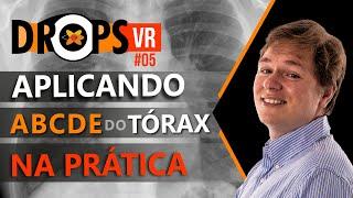 EXEMPLO PRÁTICO APLICANDO O ABCDE DO TÓRAX - RELEMBRE OS SINAIS DO DUPLO CONTORNO