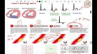 Sindrom Koroner Akut (SKA/ACS) - EKG, Patofisiologi, Diagnosis, Tatalaksana