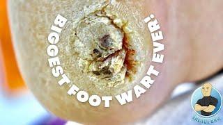 THE BIGGEST FOOT WART EVER??? ***PLANTAR WART REMOVAL SURGERY***