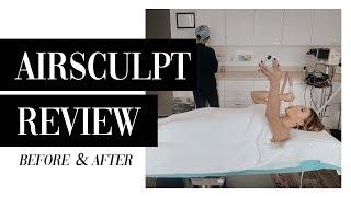 5-Month Airsculpt Review | Before & After