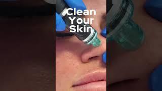 Hydrafacial zur Reinigung der Haut ‍️#hydrafacial #ehrenarzt #beautydoc #akne #acne #skincare