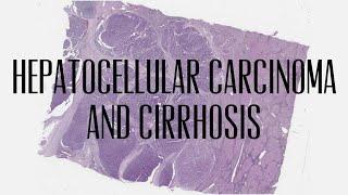 12  hepatocellular carcinoma and cirrhosis