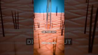 How Splinters Get Unstuck  Surgeon Reacts