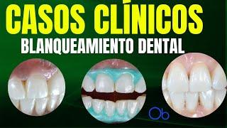 Casos Clínicos de Blanqueamiento Dental