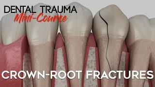 Dental Trauma Mini-Course - Part 5 - Dental Trauma Guide - Crown-Root Fractures