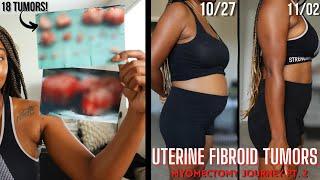 Fibroid Surgery Story [GRAPHIC CONTENT]  | Myomectomy + 1st Week Home after Uterine Fibroid Removal