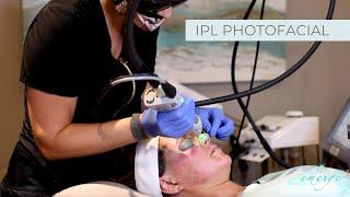 IPL Photofacial