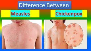 Difference between Measles and Chickenpox