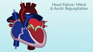 Rheumatic Heart Disease by E. Rusingiza | OPENPediatrics