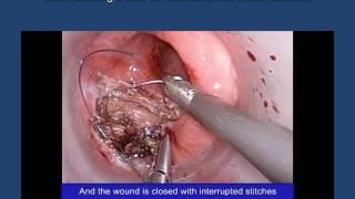 Transanal Minimally invasive surgery (TAMIS) for Excision of Rectal Carcinoid