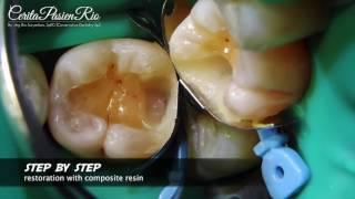 class II restoration with cavity refining using ultrasonic excavus (tambalan resin komposit)