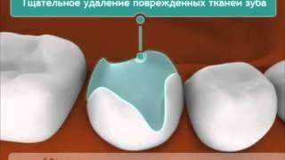 Керамические вкладки
