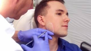 Chin mandible augmentation - Fillers in the jawline area