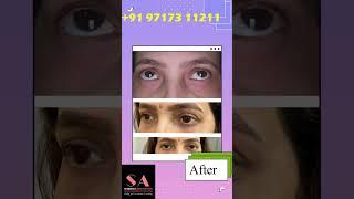 Lower Eyes Fat Grafting | Fat Grafting of Lower Eyelid | Dr Shobhit Gupta