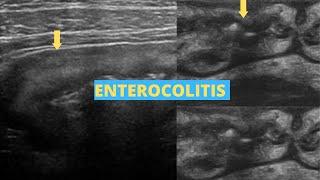 Enterocolitis | Ultrasound Case