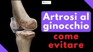 ARTROSI al ginocchio: come evitare