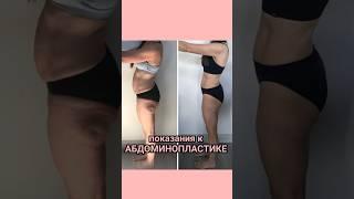 Абдоминопластика ️ https://seoulguidemedical.com/ #абдоминопластика #пластикавкорее
