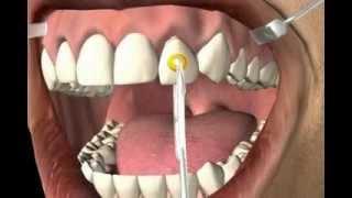 Dental Crown Removal