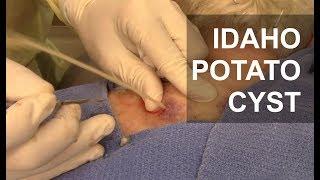 EXPLOSIVE Idaho Potato Cyst!! | Dr. Derm