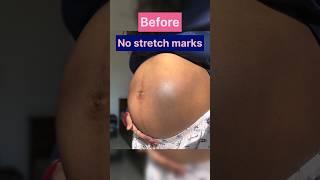 No stretch marks | Here are some tips which I followed #skincare #shorts #youtubeshorts