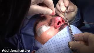 Wide Nose/ Mild Hump & Droopy Tip-63: Rhinoplasty Bizrah- London/Dubai- Dr. Bizrah