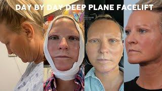 Day by Day Deep Plane Facelift Recovery (6 weeks post-op)