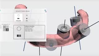 3DBioCAD - 3Shape Implant Studio 무치아: Surgical Guide 디자인법