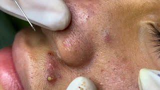 The best acne squeezing collection form Linh Mun Spa part 16