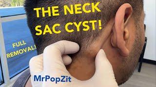 The neck sac cyst.Full removal of contents and sac. 6 week follow up at the end . See how it healed!