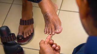 The Diabetic Foot Exam - Diabetes Series