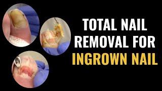 Total Nail Removal For Ingrown Toenail