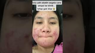 Cerita pengalaman berjuang melawan jerawat ada di youtube . #acne #jerawat