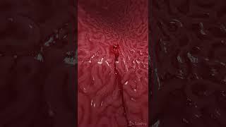Bleeding gastric ulcer 3d animation  #anatomy #meded