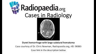 Duret hemorrhage with large subdural hematoma (Radiopaedia.org) Cases in Radiology