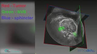 MRI to Ultrasound Fusion by RSIP Vision