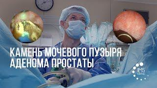 Камень мочевого пузыря и аденома простаты. Лазерное дробление и плазменная абляция.