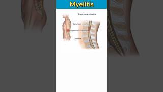 Neuralgia nerve pain and Myelitis inflammation of spinal card #shortsvideo