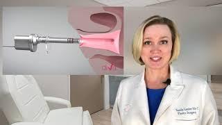 diVa® Laser: Noninvasive Vaginal Rejuvenation