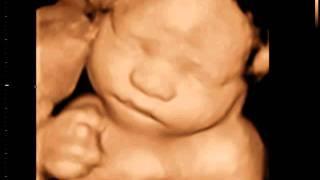 3D Ultrasound Coquitlam | 3D Sono Image