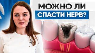 Сохраняем зубной нерв. Можно ли вылечить пульпит без удаления нерва?