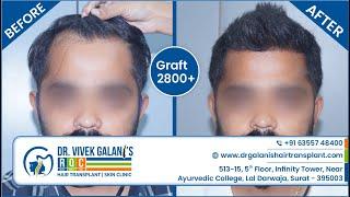 Best Hair Transplant Clinic In Surat 2021 | Before & After Result | Grafts 2800+ | 6 Months Update