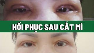 Quá trình hồi phục sau khi cắt mí | Bác sĩ Trọng