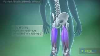 Scheuermann’s kyphosis Symptoms