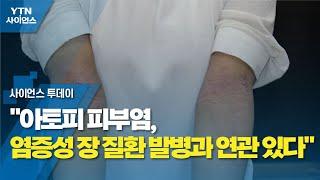 "아토피 피부염, 염증성 장 질환 발병과 연관 있다" / YTN 사이언스