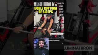 DOBLE RUPTURA DE BICEPS 