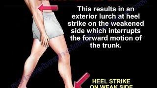 Gluteus Maximus Gait - Everything You Need To Know - Dr. Nabil Ebraheim