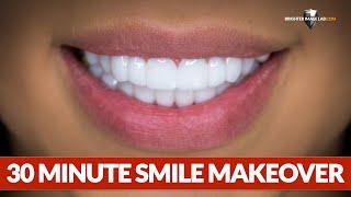 Dental Veneers - This Smile Makeover Took 30 Minutes by Brighter Image Lab!