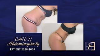 VASER Abdominoplasty Post Weight Loss (Patient 2020-1009)